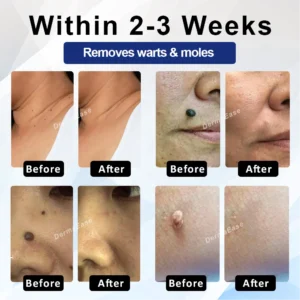 ATTDX® DermaSoft Tag & Mole Clear Gel
