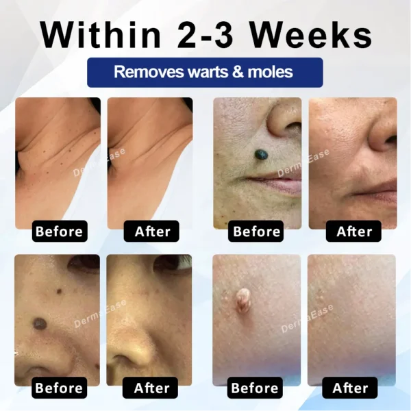 ATTDX® DermaSoft Tag & Mole Clear Gel