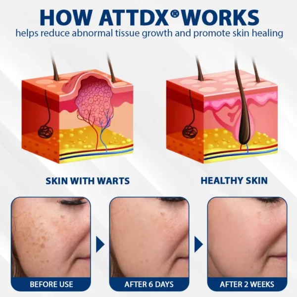 ATTDX® DermaSoft Tag & Mole Clear Gel