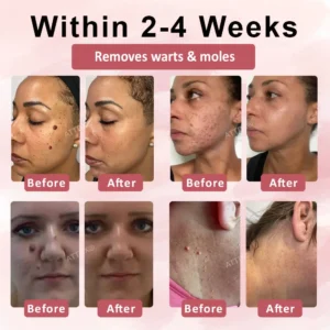 ATTDX® Tag & Blemish Peel-Off Gel Wrapping Mask