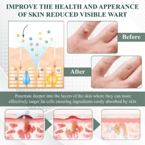 ATTDX® Tea Tree Focused WartAway MicroDart Patch