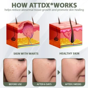 ATTDX® Tea Tree Focused WartAway MicroDart Patch