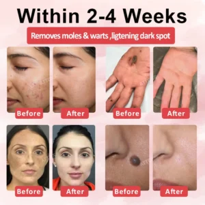 ATTDX® Wart & Spot Erase Advanced Particle Serum