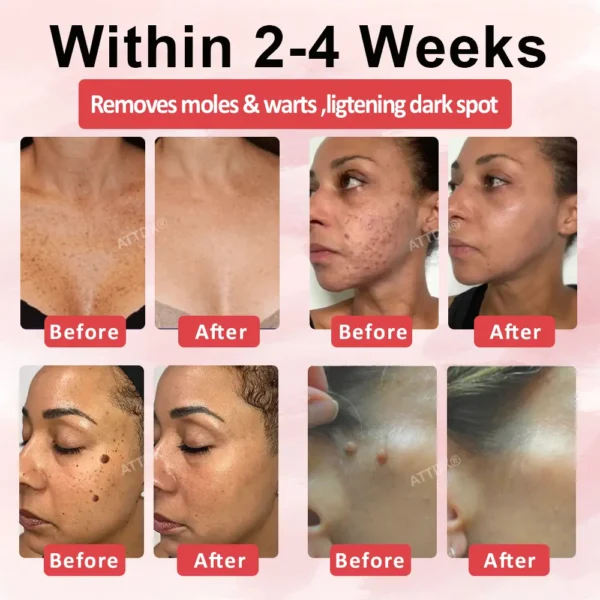 ATTDX® Wart & Spot Erase Advanced Particle Serum