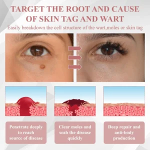 ATTDX® Wart & Spot Erase Advanced Particle Serum