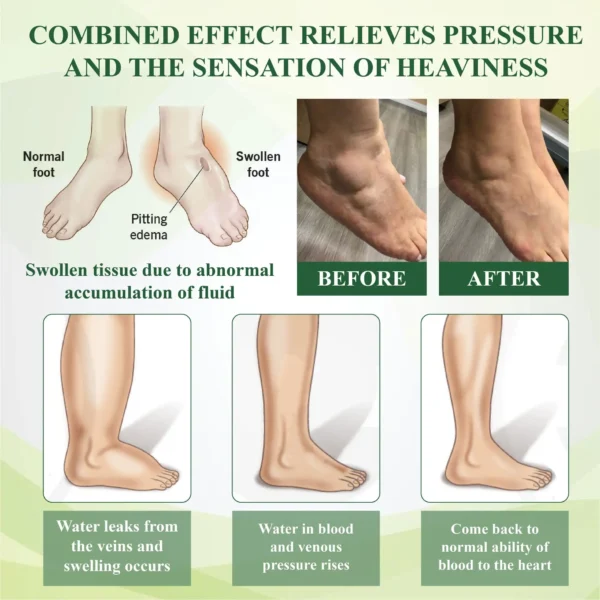 ATTDX® CircuFlex Leg Therapy Edema Spray