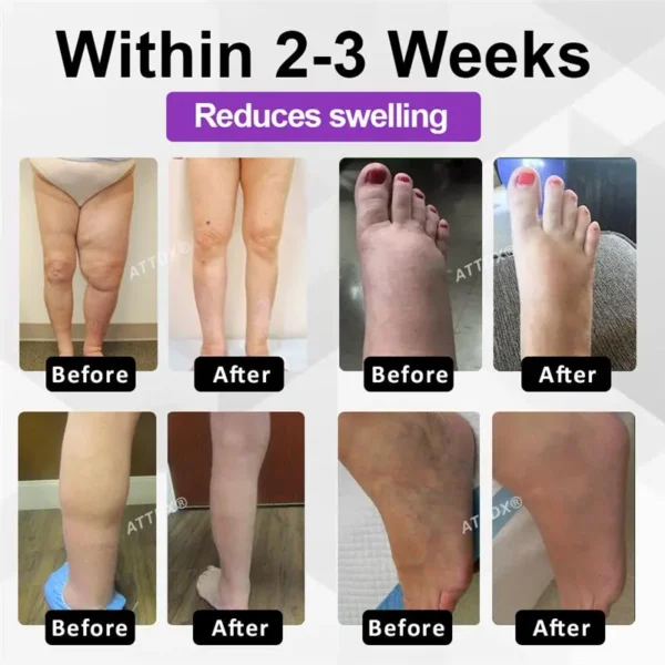 ATTDX® Bilberry EaseFluid Edema Gel