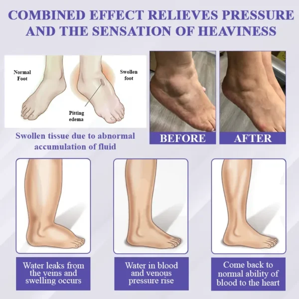 ATTDX® Bilberry EaseFluid Edema Gel