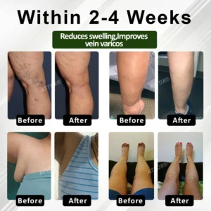 ATTDX® FluidEase Leg Therapy Edema Cream 2