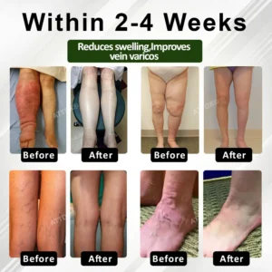 ATTDX® FluidEase Leg Therapy Edema Cream 2