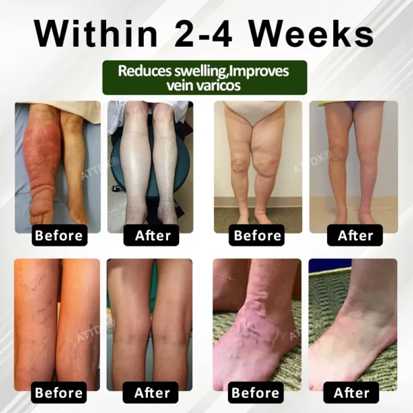 ATTDX® FluidEase Leg Therapy Edema Cream 2