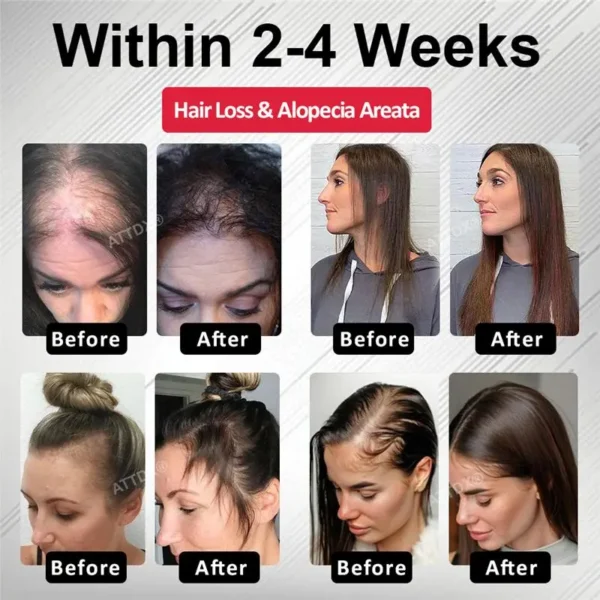 ATTDX® Hair Reawaken PP405 Roll-On Serum for Women 👩