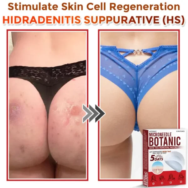 ATTDX® MicroNeedle Botanic Skin Tag Removal Patch