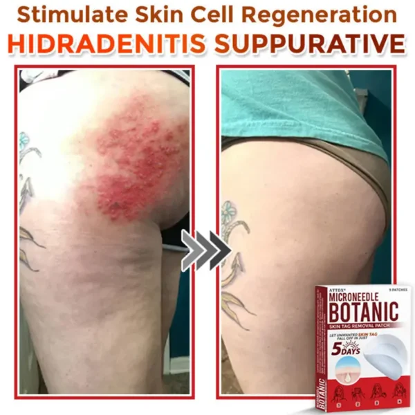 ATTDX® MicroNeedle Botanic Skin Tag Removal Patch