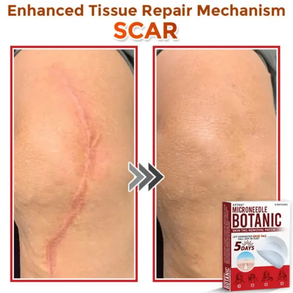 ATTDX® MicroNeedle Botanic Skin Tag Removal Patch