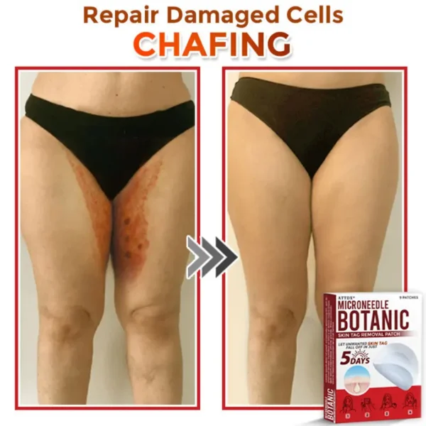 ATTDX® MicroNeedle Botanic Skin Tag Removal Patch