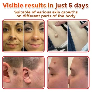 ATTDX® MicroNeedle Botanic Skin Tag Removal Patch
