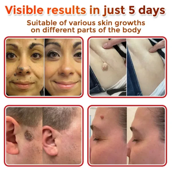 ATTDX® MicroNeedle Botanic Skin Tag Removal Patch