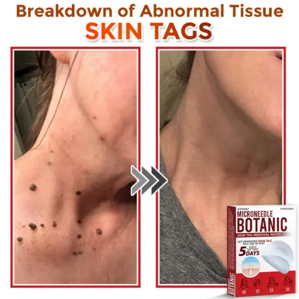 ATTDX® MicroNeedle Botanic Skin Tag Removal Patch