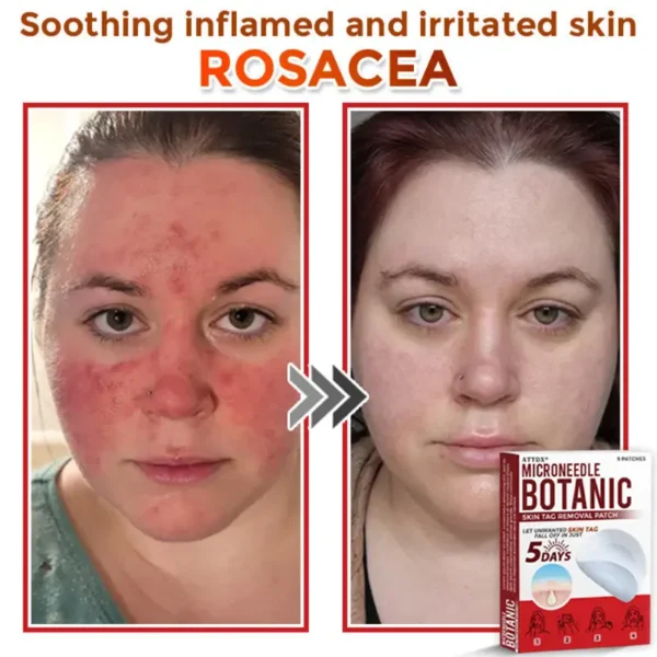 ATTDX® MicroNeedle Botanic Skin Tag Removal Patch