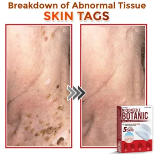 ATTDX® MicroNeedle Botanic Skin Tag Removal Patch