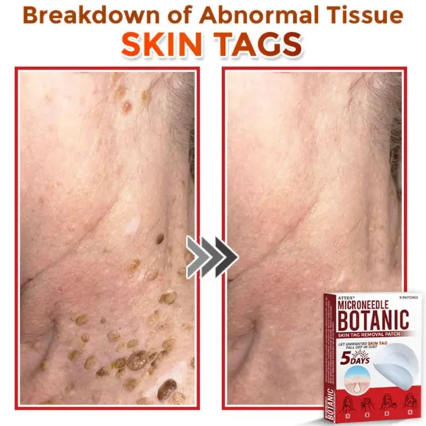 ATTDX® MicroNeedle Botanic Skin Tag Removal Patch