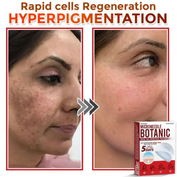 ATTDX® MicroNeedle Botanic Skin Tag Removal Patch