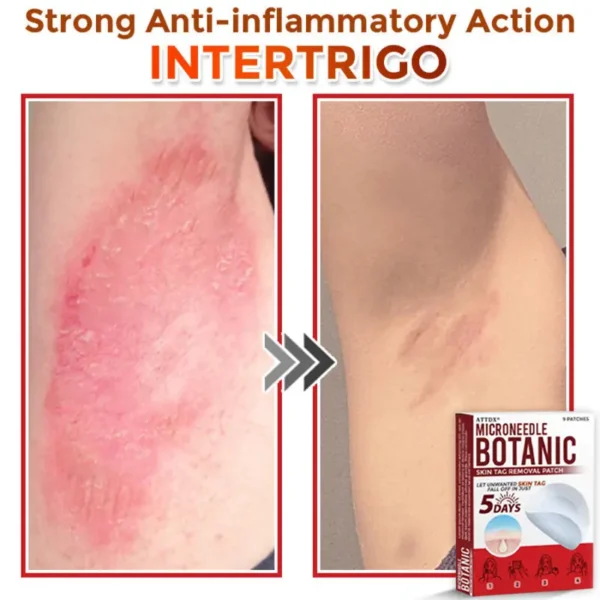 ATTDX® MicroNeedle Botanic Skin Tag Removal Patch