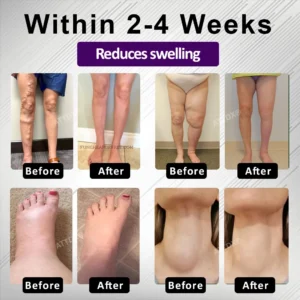 ATTDX® NightDrain Leg Therapy Edema Cream