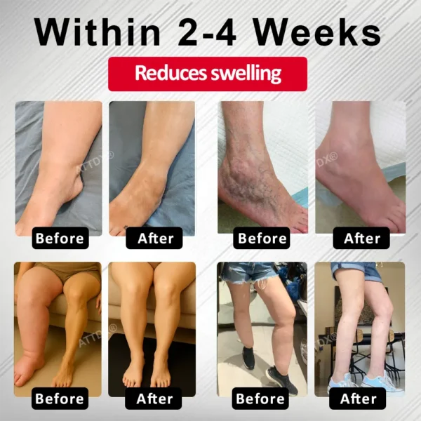 ATTDX® Advanced CVI Edema Therapy Cream