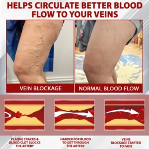 ATTDX® Advanced CVI Edema Therapy Cream
