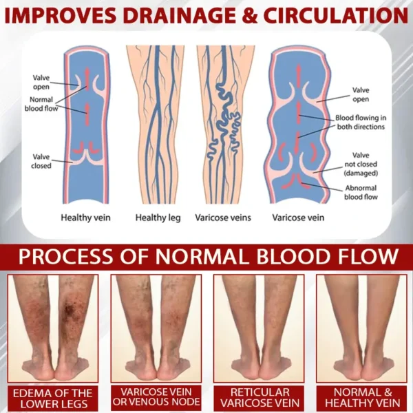 ATTDX® Advanced CVI Edema Therapy Cream