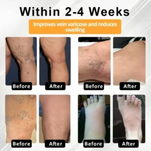 ATTDX® MicroSting Bee Vein Ease Patches