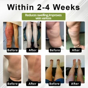 ATTDX® VeinoRoll Therapy Edema Comfort Cream