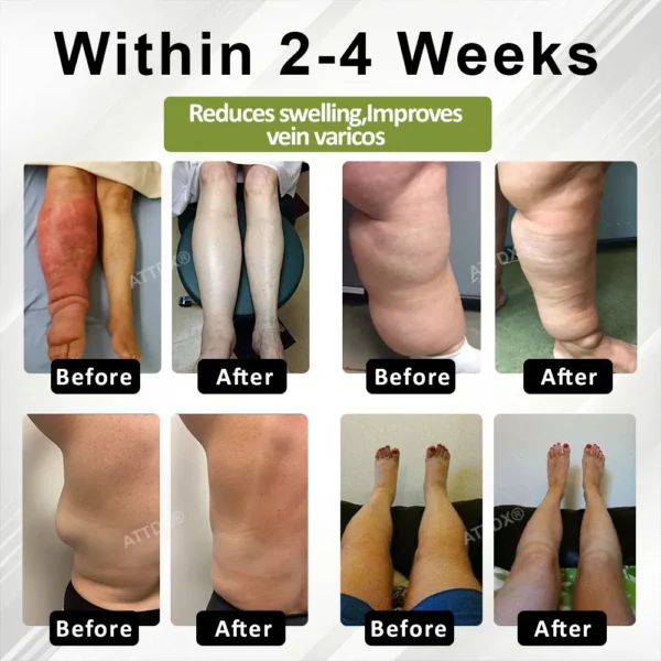 ATTDX® VeinoRoll Therapy Edema Comfort Cream