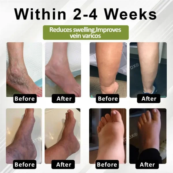 ATTDX® VeinoRoll Therapy Edema Comfort Cream