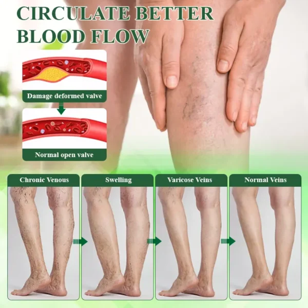 ATTDX® VeinoRoll Therapy Edema Comfort Cream